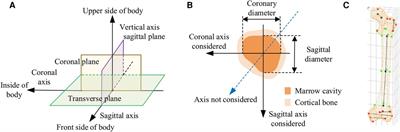 Monte Carlo-based in-depth morphological analysis of medullary cavity for designing personalized femoral stem